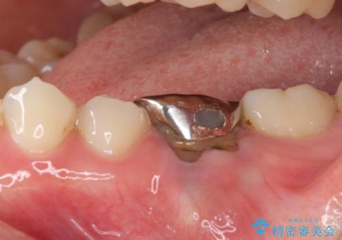 前歯のデコボコを治したい ワイヤー矯正の治療中