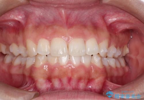 インビザラインを用いた叢生(歯並びのガタつき)の治療の治療中