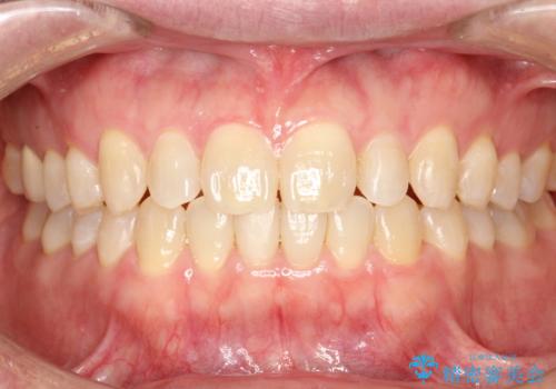前歯の真ん中の隙間を閉じたい　インビザラインによる目立たない矯正の症例 治療後