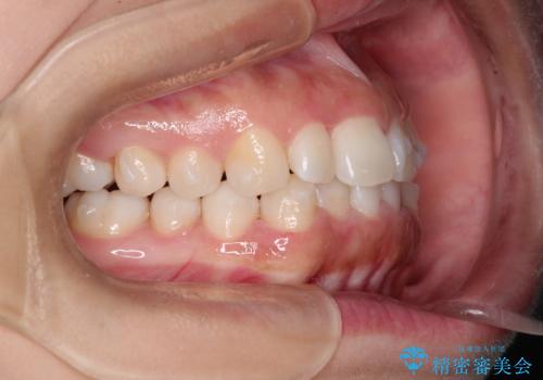 インビザラインを用いた叢生(歯並びのガタつき)の治療の治療中