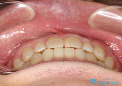 前歯の真ん中の隙間を閉じたい インビザラインによる目立たない矯正の治療後