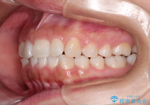 インビザラインを用いた叢生(歯並びのガタつき)の治療の治療中