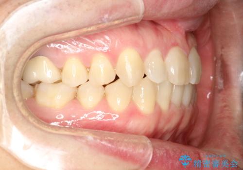 前歯の真ん中の隙間を閉じたい インビザラインによる目立たない矯正の治療後