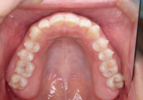 インビザラインを用いた叢生(歯並びのガタつき)の治療の治療中