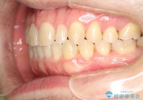 前歯の真ん中の隙間を閉じたい　インビザラインによる目立たない矯正の治療後
