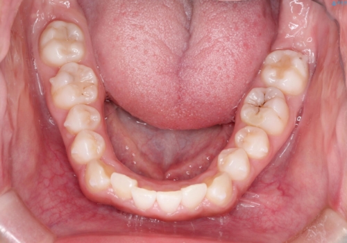 インビザラインを用いた叢生(歯並びのガタつき)の治療の治療中