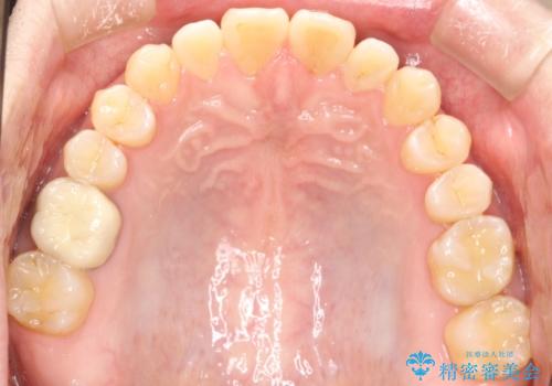 前歯の真ん中の隙間を閉じたい インビザラインによる目立たない矯正の治療後