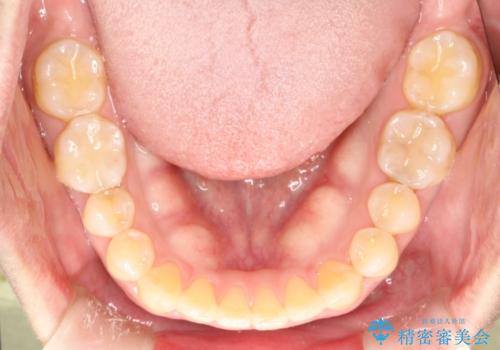前歯の真ん中の隙間を閉じたい　インビザラインによる目立たない矯正の治療後