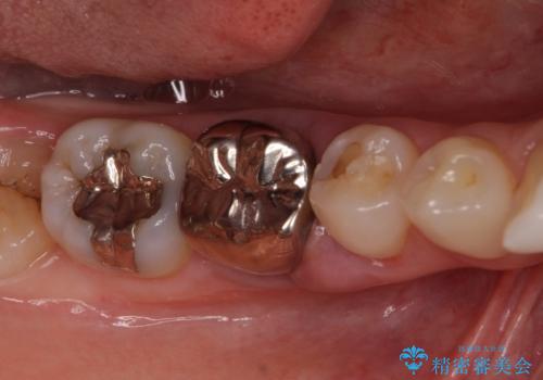 折れてしまった奥歯 下の奥歯のインプラント治療の症例 治療前