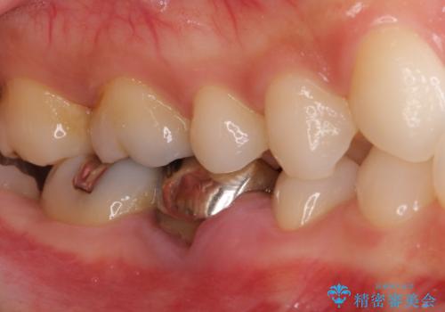 折れてしまった奥歯 下の奥歯のインプラント治療の治療前