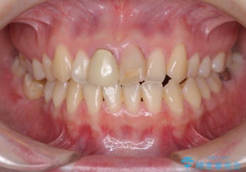 変色した前歯のオールセラミック治療の治療前