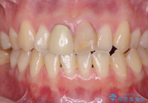 変色した前歯のオールセラミック治療の治療前