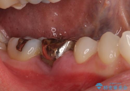 折れてしまった奥歯 下の奥歯のインプラント治療の治療前