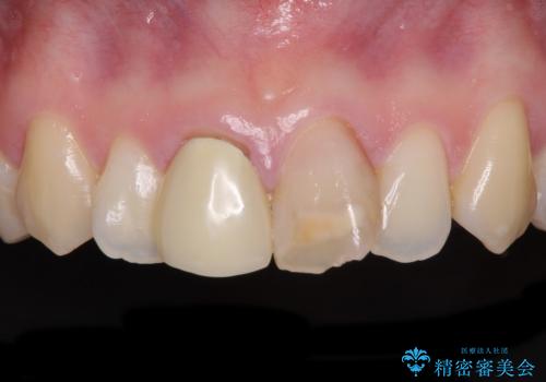 変色した前歯のオールセラミック治療の症例 治療前