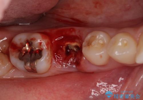 折れてしまった奥歯 下の奥歯のインプラント治療の治療前