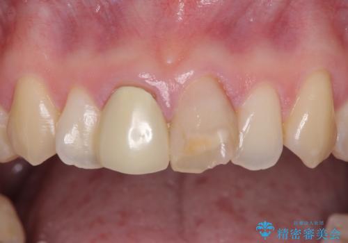 変色した前歯のオールセラミック治療の治療前
