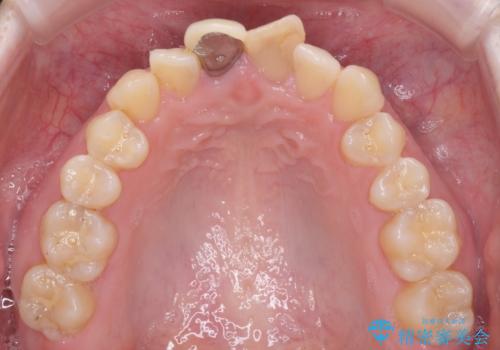 変色した前歯のオールセラミック治療の治療前