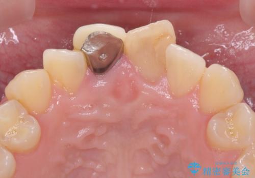 変色した前歯のオールセラミック治療の治療前