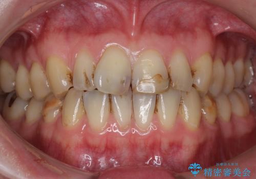 前歯のつめもの きれいにしたい 30代男性の治療前