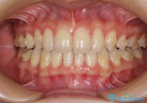 抜歯矯正の後戻りによるすきっ歯をインビザラインでの治療中