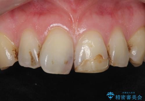 前歯のつめもの きれいにしたい 30代男性の治療前
