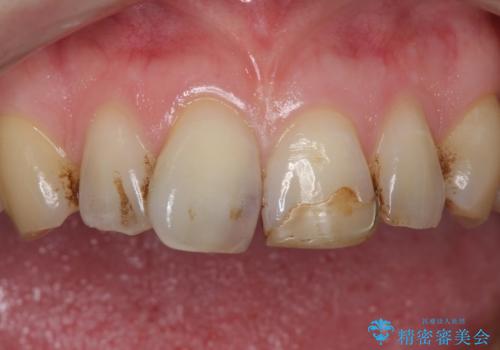 前歯のつめもの きれいにしたい 30代男性の治療前