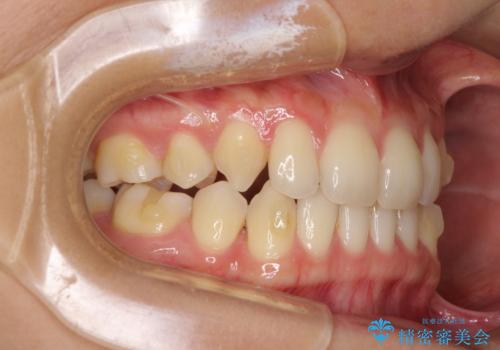 抜歯矯正の後戻りによるすきっ歯をインビザラインでの治療中