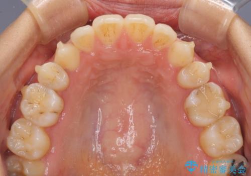 抜歯矯正の後戻りによるすきっ歯をインビザラインでの治療中