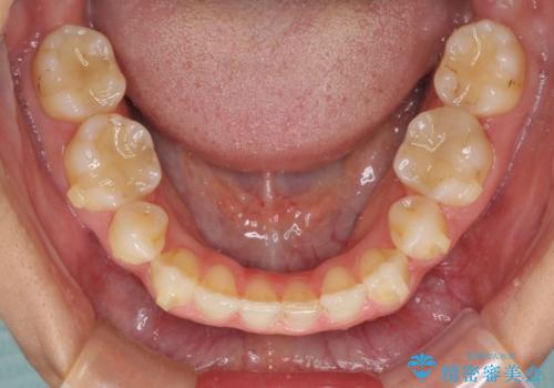 抜歯矯正の後戻りによるすきっ歯をインビザラインでの治療中