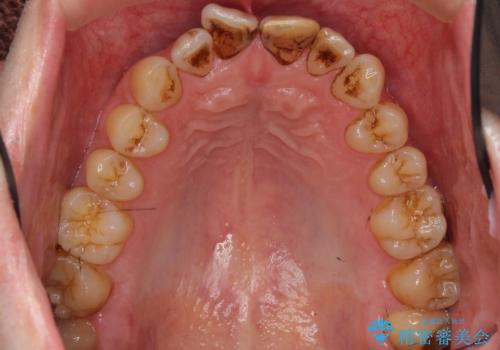 前歯のつめもの きれいにしたい 30代男性の治療前