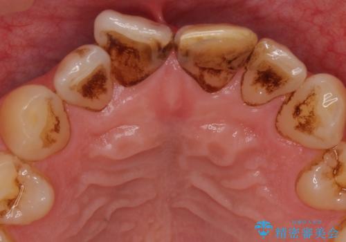 前歯のつめもの きれいにしたい 30代男性の治療前