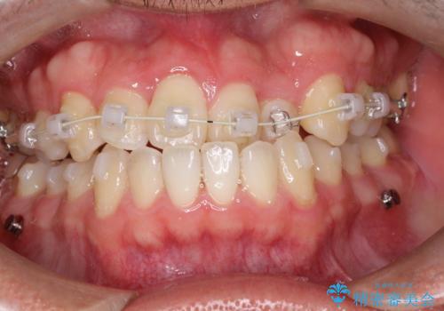 前歯が反対にかんでいる　インビザラインとワイヤーを組み合わせた矯正治療の治療中