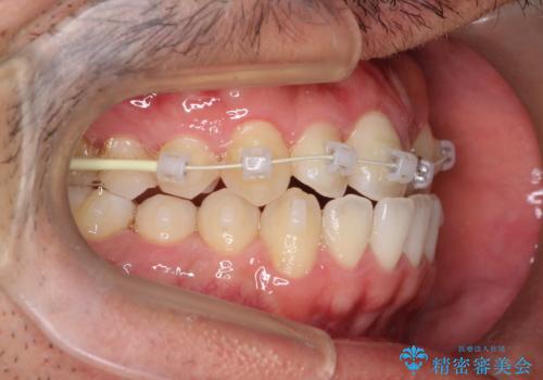 前歯が反対にかんでいる インビザラインとワイヤーを組み合わせた矯正治療の治療中