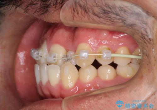 前歯が反対にかんでいる インビザラインとワイヤーを組み合わせた矯正治療の治療中