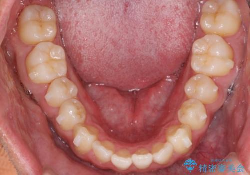前歯が反対にかんでいる インビザラインとワイヤーを組み合わせた矯正治療の治療中