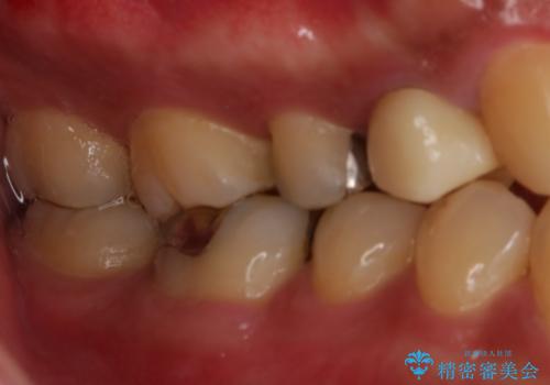 銀歯をセラミックにの治療前
