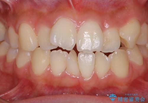 矯正治療開始前のPMTCの治療前