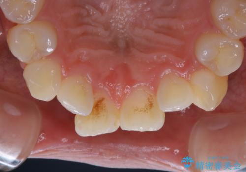 矯正治療開始前のPMTC