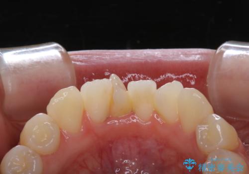 矯正治療開始前のPMTCの治療前