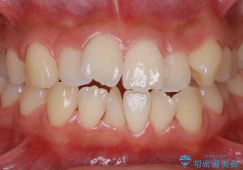 矯正治療開始前のPMTCの治療後