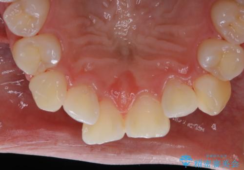矯正治療開始前のPMTCの治療後
