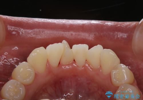 矯正治療開始前のPMTCの治療後