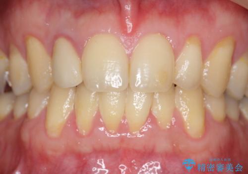 オールセラミッククラウン メタルフリーのクラウンへの治療前