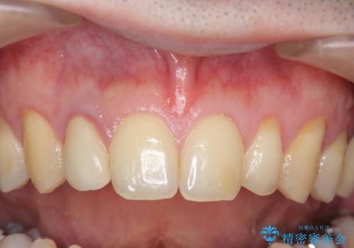 オールセラミッククラウン メタルフリーのクラウンへの症例 治療前