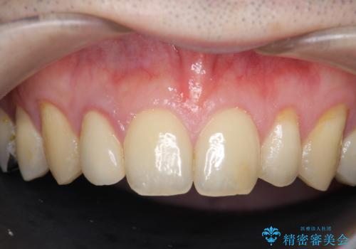 オールセラミッククラウン メタルフリーのクラウンへの治療前