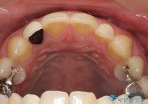 オールセラミッククラウン メタルフリーのクラウンへの治療前