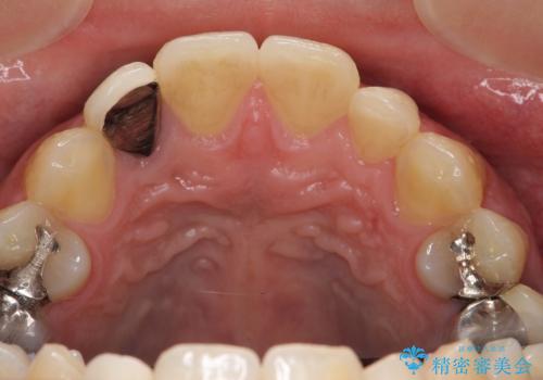 オールセラミッククラウン メタルフリーのクラウンへの治療前