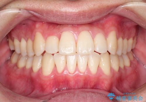 前歯のクロスバイトとガタつきをマウスピース矯正(インビザライン )で治療した症例の症例 治療後