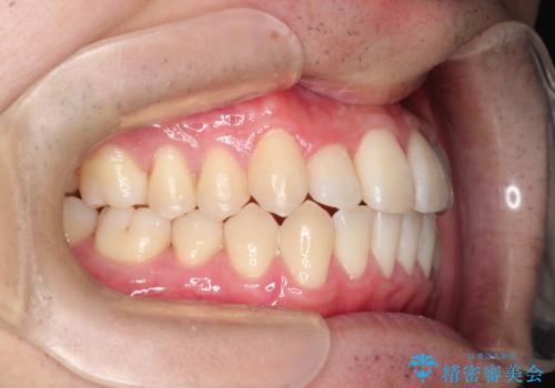 前歯のクロスバイトとガタつきをマウスピース矯正(インビザライン )で治療した症例の治療後