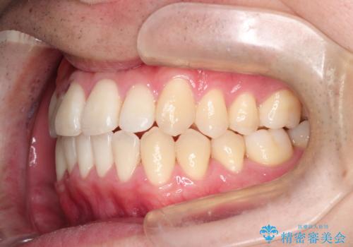 前歯のクロスバイトとガタつきをマウスピース矯正(インビザライン )で治療した症例の治療後
